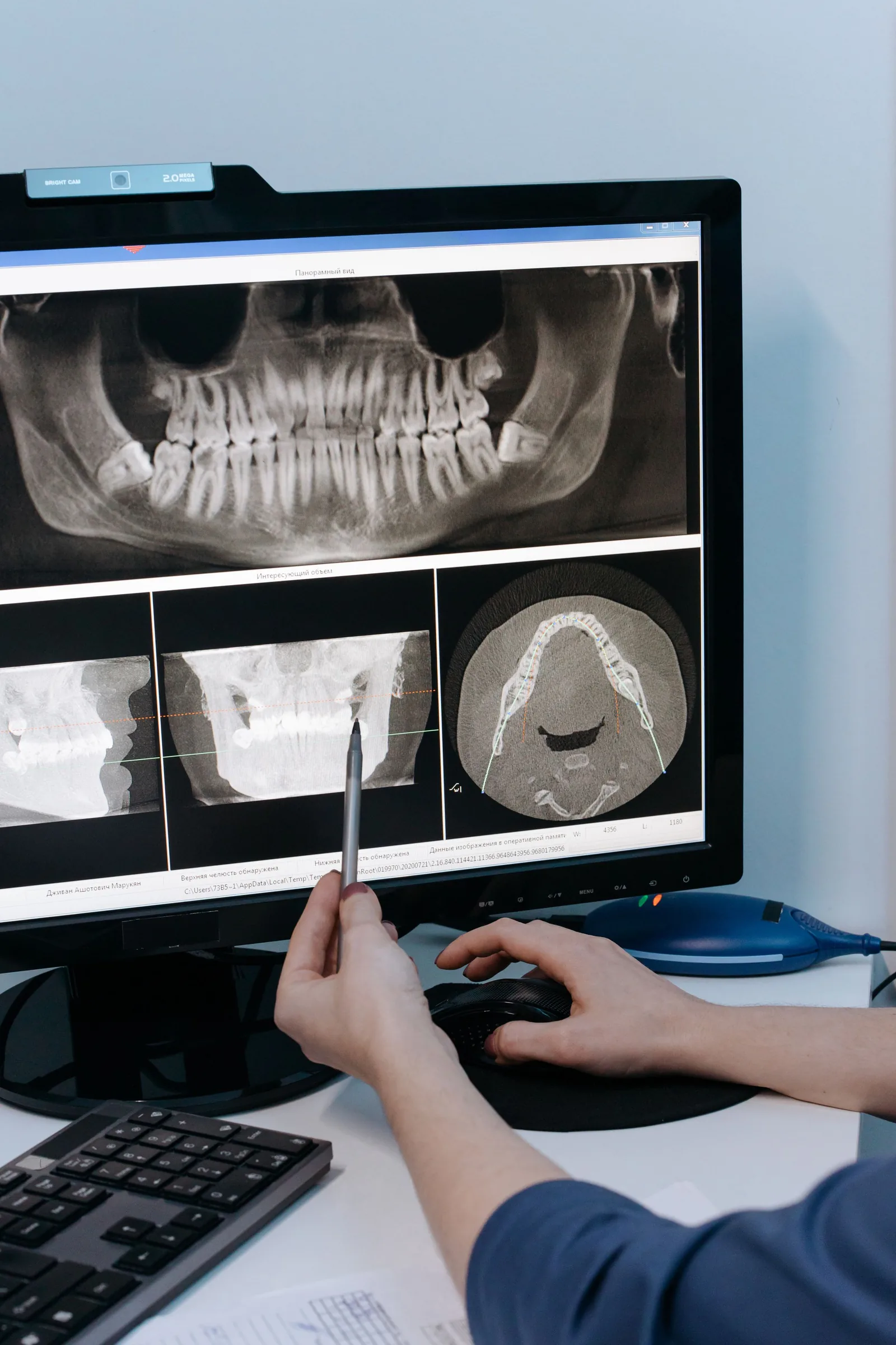 A panoramic X-ray and CBCT cross-sections on screen during implant planning